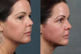 What are the advantages of using ultherapy? Ultherapy Answers To Frequently Asked Questions Blush