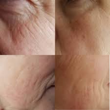 Zinksalbe gegen pickel schafft abhilfe: Microdermabrasion Akne Falten Behandeln In Bamberg