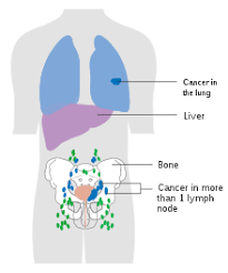 Bladder Cancer Wikipedia