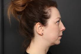 Square face shapes have a more angular jawline and a straighter chin. Weak Chin Treatment Dermal Fillers At Define Medical Clinic Beaconsfield