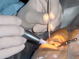 Image result for Cataract Extraction