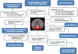 Check spelling or type a new query. Sarcopenia In Cirrhosis From Pathogenesis To Interventions Springerlink