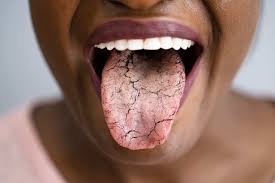 Image result for brown tongue symptoms