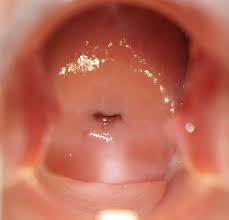 Cervical Dysplasia Treatment Options Posts Facebook