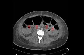 Image result for Megacolon