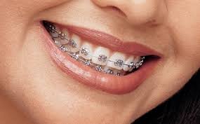 Image result for braces