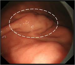 We found a granuloma surrounding the suture. Eosinophil Granuloma Due To Parasite Treated By Laparoscopic And Endoscopic Cooperative Surgery A Case Report Surgical Case Reports Full Text