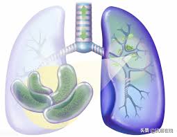 肺結核，又稱結核病 (tuberculosis, tb)， 是一種會攻擊、破壞身體組織的細菌性感染，菌種名是結核分枝桿菌 (mycobacterium tuberculosis, mtb) ，傳播途徑是空氣。 許多病患常受結核休眠菌影響，又稱作潛伏結核 (latent tuberculosis) ，視病人健康狀態而定，結核菌可能會在數週或數年後再次引起症狀，使肺結核. è‚ºçµæ ¸ç®—æ˜¯é‡å¤§ç–¾ç—…å—Ž æŠ—ç™†åœ¨ç·š Mdeditor