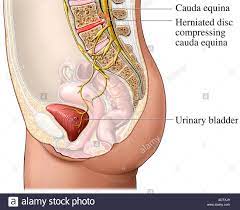 Cauda Equina Syndrome High Resolution Stock Photography And Images Alamy