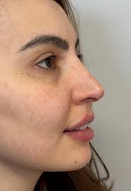 Harmonização Facial
