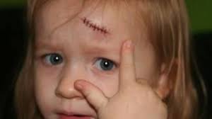 How long can you wait for stitches? How To Determine If A Cut Needs Stitches 9 Steps With Pictures