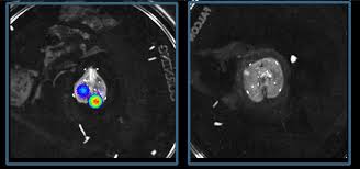 The break might take place in an area of the bone that had other symptoms, such as trouble breathing, might develop if the cancer has actually spread to other organs. A New Route To Blocking Children S Bone Cancer Eurekalert Science News