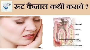 Root canal treatment, prices, procedure, and other information. Root Canal Treatment Marathi à¤° à¤Ÿ à¤• à¤¨ à¤² à¤Ÿ à¤° à¤Ÿà¤® à¤Ÿ Youtube