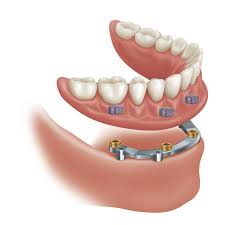 Descubra 12 Tipos Diferentes De Protese Dentaria Dr Henrique Masson