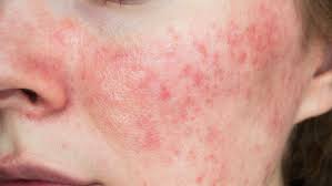 Quando eu como pimenta ou alguma comida bem picante, apresento piora em  minha pele e meus olhos ficam vermelhos e queimando....isso tem cabimento?  - Clínica de Olhos Arruda Mello