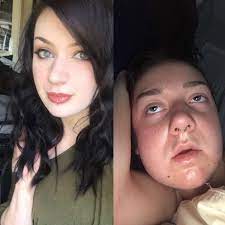 Wisdom teeth removal can leave with you puffed out, swollen cheeks. Swelling After Wisdom Teeth Removal Reddit Teethwalls
