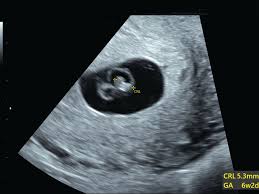 An Imaging Approach To Early Pregnancy Failure Contemporary Ob Gyn