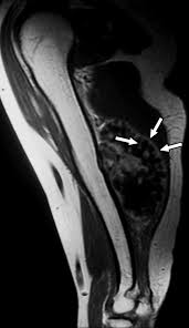 Image result for Chondrosarcoma
