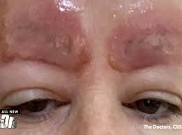 A lot of women often think that microblading and brow tattooing is the same thing because it sounds like a similar, painful process. Microblading Warning After Semi Permanent Tattoo Caused Woman S Eyebrows To Swell And Scab The Independent The Independent