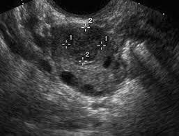 Ovarian cancer starts in the cells lining the ovaries. Adnexal Masses Us Characterization And Reporting Radiology