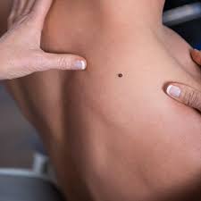 Leave the treatment overnight and shower off in the morning. Benign Growth Removal Skin Tags Moles Etc