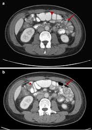 Image result for Neutropenic Colitis
