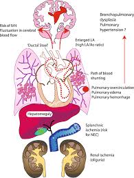Image result for Delayed Transition from Fetal Circulation