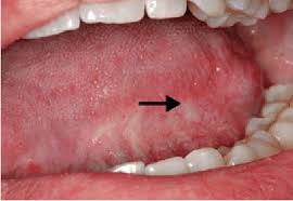 Image result for white cancer on tongue)