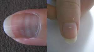 Image result for Muehrcke Line