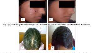Effect Of Metformin Therapy In Female Visiting Dermatologist For Acne Vulgaris Having Endocrine And Sonographic Characteristics Of Polycystic Ovary Syndrome Pcos Semantic Scholar