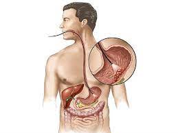 Stomach cancer is an abnormal growth of cells that begins in the stomach. à®µà®¯ à®± à®± à®ª à®± à®± à®¨ à®¯ à® à®± à®¤ à®¤ à®à® à®à®³ à® à® à®¤ à®¤ à®° à®¯ à®¤ à® à®² à®à®£ à®® à®à®³ Facts About Stomach Cancer Tamil Boldsky