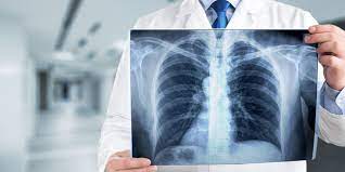 Sieht seine aufgaben einerseits in der beratung und aufklärung von menschen, die unter copd oder einer anderen lungenerkrankung leiden. An Diesen Symptomen Erkennen Sie Ein Lungenemphysem