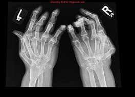 Pain and stiffness often worsen following rest. Rheumatoid Arthritis X Ray Wikidoc