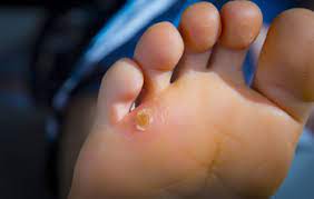Pictures of corns on feet. Types Of Corns On The Feet