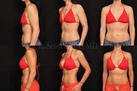 Breast Enhancement Surgery In Miami At The Four Seasons Tower Beca