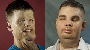 Face transplant recipient finally speaks