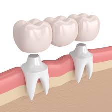 You will sit in a reclining position in the dentist chair and wear a clear shield over your eyes. Dedicated Dental Blog Benefits Of Dental Bridges
