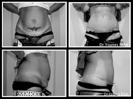 Ne perdez plus votre temps à essayer les méthodes multiples peu efficaces et parfois dangereuses pour. Dr Riah Chirurgie Esthetique Bastia Abdominoplastie