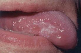 Image result for papillomavirus tongue)