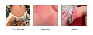 Image result for diaper dermatitis