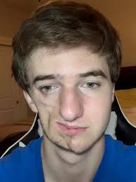 Conoce la historia de Lukas y su lucha con el síndrome de Parry-Romberg