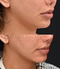 Do you see that natural and defined jawline? ✨✨ Jawline and neck contouring  with Submental Liposuction by @drdonyoo 💫 The neck contour is critical in  the overall aesthetics of the profile. The