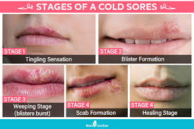 It can also irritate the sore, worsening the appearance of the cold sore and increasing. How Common Are Cold Sores Fever Blisters During Pregnancy