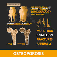 Food and your bones — osteoporosis nutrition guidelines. Osteoporosis Florida Orthopaedic Institute