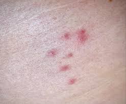 Image result for flea bites