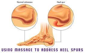 What are the symptoms of a bone heel spur? Treatment For Heel Spurs Massage Professionals Update