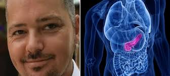 Le diagnosticaron ciática por su dolor de espalda, pero poco después murió  de cáncer de páncreas