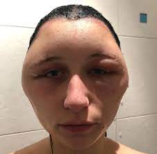If you're allergic to ppd, your scalp and face may feel itchy and start to swell. Allergische Reaktion 19 Jahrige Nach Haarefarben In Lebensgefahr Welt