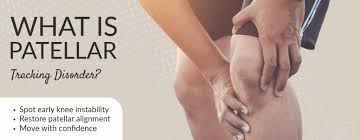 Image result for Patella Tracking Assessment
