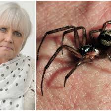What does a brown recluse spider bite look like? False Widow Spider Gave Me Black Eye Mum Says Bite Left Her Head Like A Sponge Cambridgeshire Live